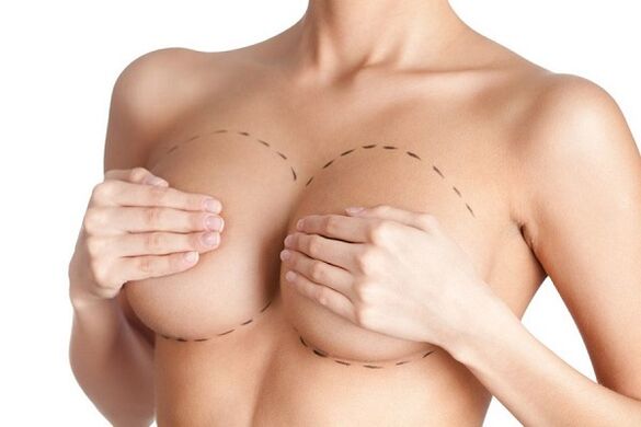 Σήμανση για χειρουργική επέμβαση αύξησης του μαστού