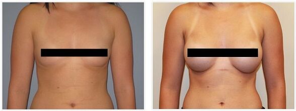 Στήθη πριν και μετά τη χειρουργική επέμβαση