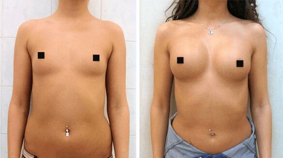 Φωτογραφίες πριν και μετά τη χειρουργική επέμβαση αύξησης του μαστού