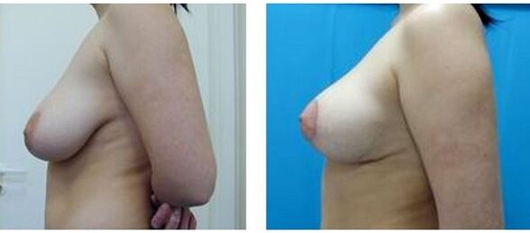 πριν και μετά τη χειρουργική επέμβαση αύξησης του μαστού
